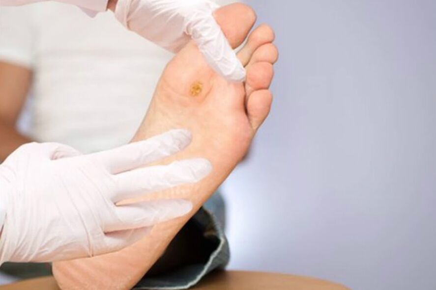 Picior diabetic - Complicație severă a diabetului